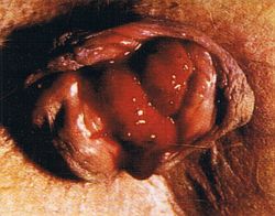 Haemorrhoiden vierten Grades