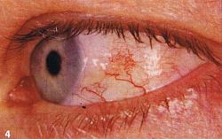 Rote sichtbare Äderchen in einem Auge